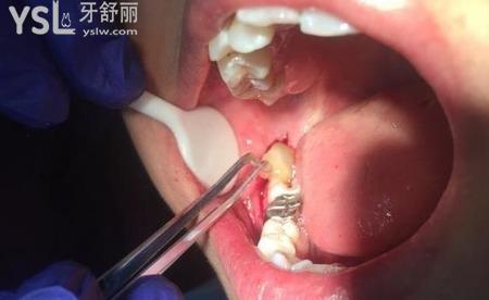 拔智齒7天后,牙洞臭但不疼,是干槽癥?