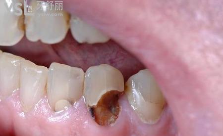 牙齒根部發(fā)炎怎么治療？