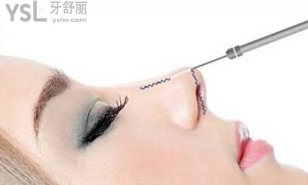 線雕隆鼻多久可以到較好狀態(tài)？