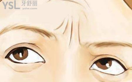 如何去掉額頭上的川字紋?