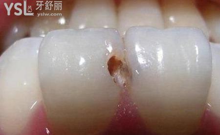 兩個(gè)牙齒之間的根部有洞,該怎么處理？