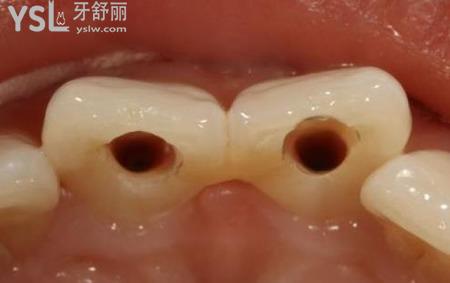 牙根尖炎能自愈嗎 牙尖根炎該怎么治療？