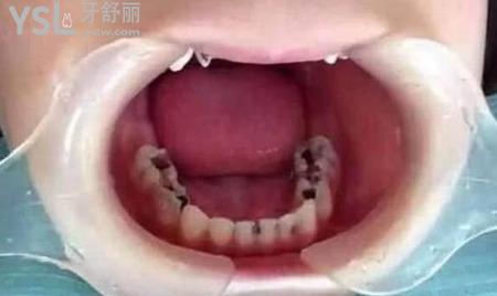 我的一顆大牙爛掉了一半了,應(yīng)該怎么辦？