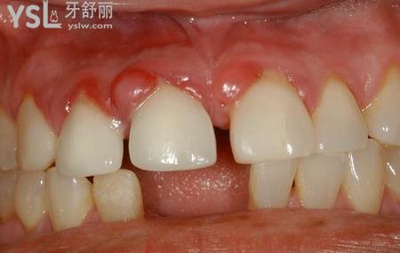 牙床上長紅色軟包很疼是什么原因?