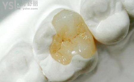 補(bǔ)蛀牙一般能保持多久?