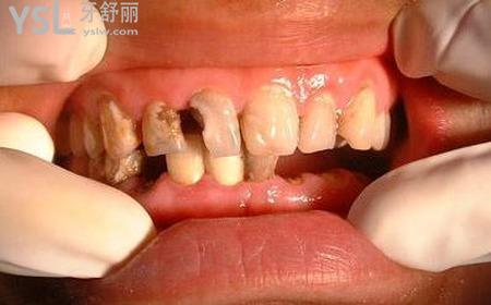小孩拔牙后多長(zhǎng)時(shí)間才能長(zhǎng)牙齒？