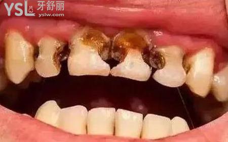 爛牙痛應(yīng)該怎么快速止痛？