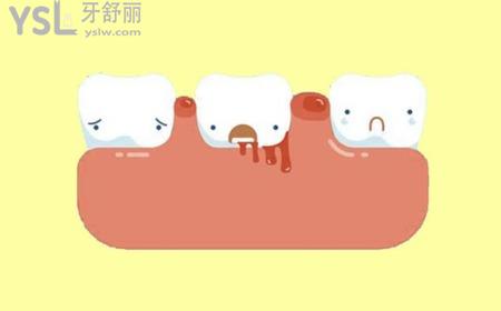 牙齒一吸就出血是什么原因？