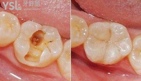 補(bǔ)牙一般可以維持多久?