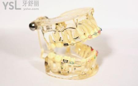 牙齒矯正前需要做什么準(zhǔn)備？