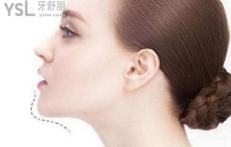 假體隆下巴術(shù)后需要多久能?