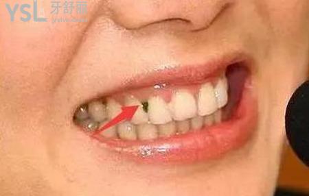 牙縫塞東西,摳出來很臭是怎么回事？