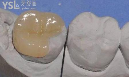 正規(guī)醫(yī)院補(bǔ)牙洞的價格是多少錢呢?