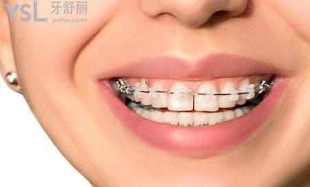 我牙齒不齊要矯正需要多少錢？