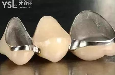 烤瓷牙是怎么安裝的？