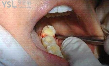 大家拔完智齒后臉都腫幾天??？