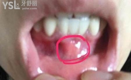牙根發(fā)炎腫得非常好的我該怎么辦呢？