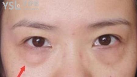 年紀(jì)輕輕眼袋就下垂怎么辦？