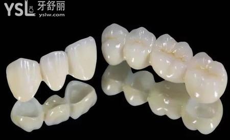 一般的全烤瓷牙多少錢一顆？