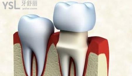 做個牙冠需要多少錢？