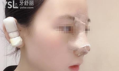 耳軟骨隆鼻是什么樣手術(shù)？