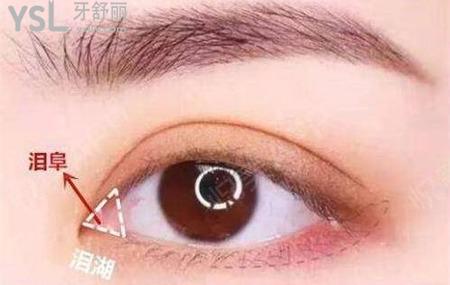什么是雙眼皮?什么人適合開外眼角?