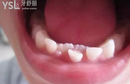 乳牙老不掉新牙都長出來了怎么辦？
