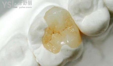 補(bǔ)牙的話一般牙科醫(yī)院多少錢一顆?