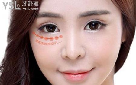 外切眼袋后多久才自然,外切眼袋注意事項有多難?