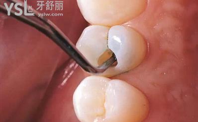 智齒爛了大洞不拔會怎么樣？