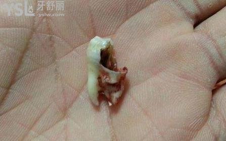 爛牙根很臭要拔掉嗎？
