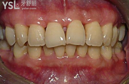 牙縫黑了洗牙可以洗掉嗎？