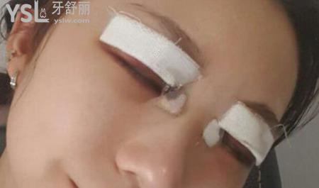 切開雙眼皮注意事項及護(hù)理？