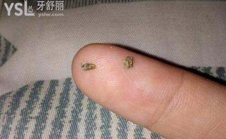牙結(jié)石怎么去除多少錢？