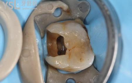 拔牙神經(jīng)痛不痛？有什么危害？