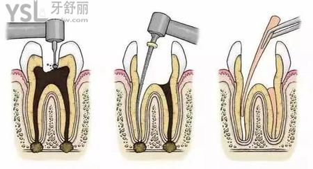 牙齒打樁要多少錢？