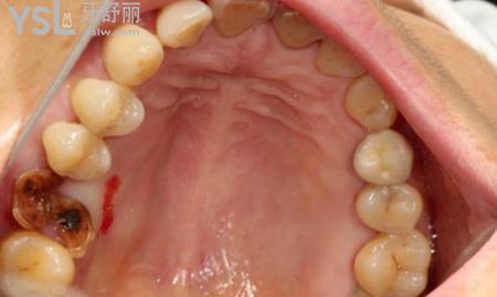 牙窩里白色物體是什么？