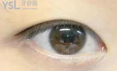 外眼角手術有什么副作用？