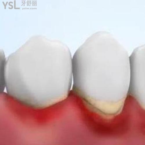 重度牙周炎有哪些癥狀？