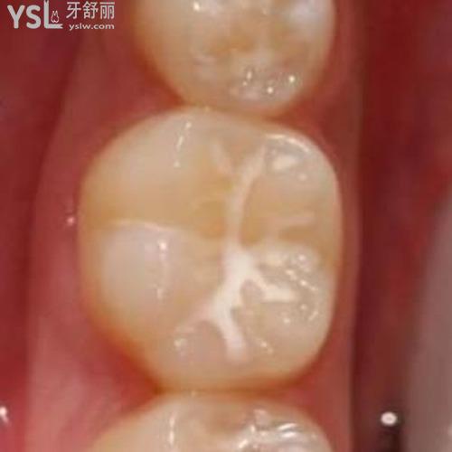 窩溝封閉后多久不能吃東西？