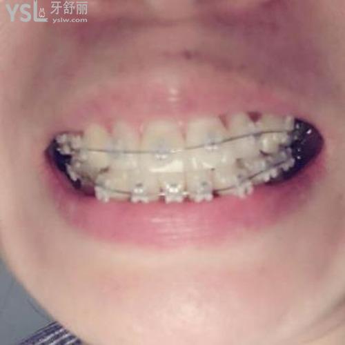 年齡大矯正牙齒的話會反彈嗎？