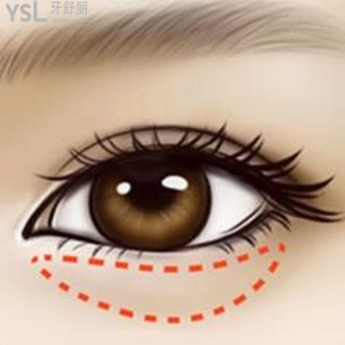 眼袋割了以后又復(fù)發(fā)了怎么辦？