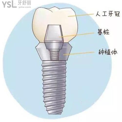 種牙疼不疼很害怕種牙？
