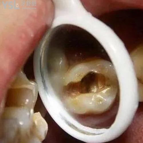 牙神經(jīng)抽掉了為什么還會(huì)疼？