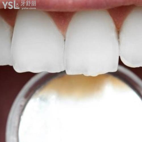 門牙可以補(bǔ)嗎掉了一點(diǎn)？
