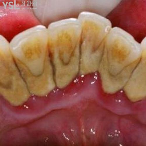 牙結(jié)石自己怎么處理？