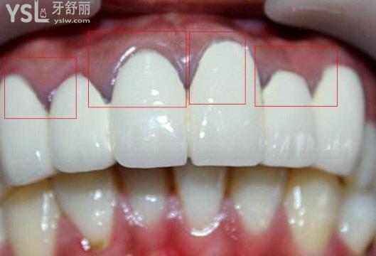 笑起來(lái)露牙床怎么辦？
