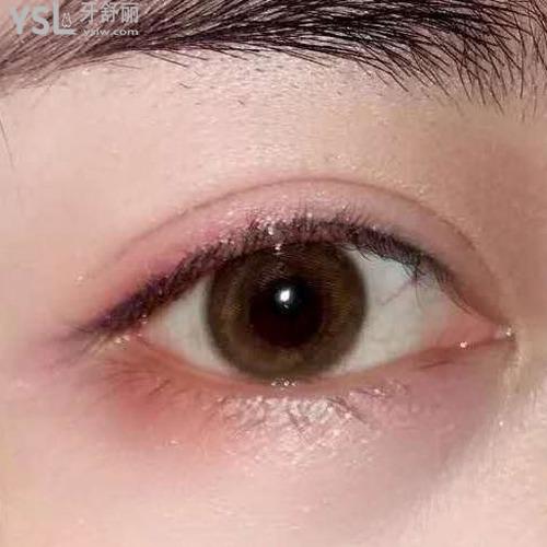 開眼角和雙眼皮一起做要多少錢？