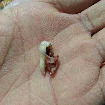 智齒蛀牙了補(bǔ)好還是拔掉好？