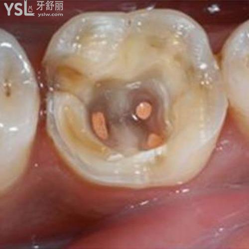 牙洞封藥后三天可以喝酒嗎？
